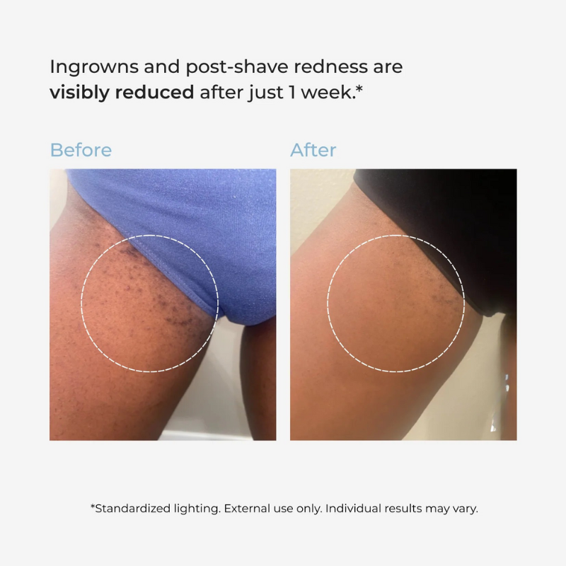 nūda.® Smoothing Solution Ingrown Hair Treatment
