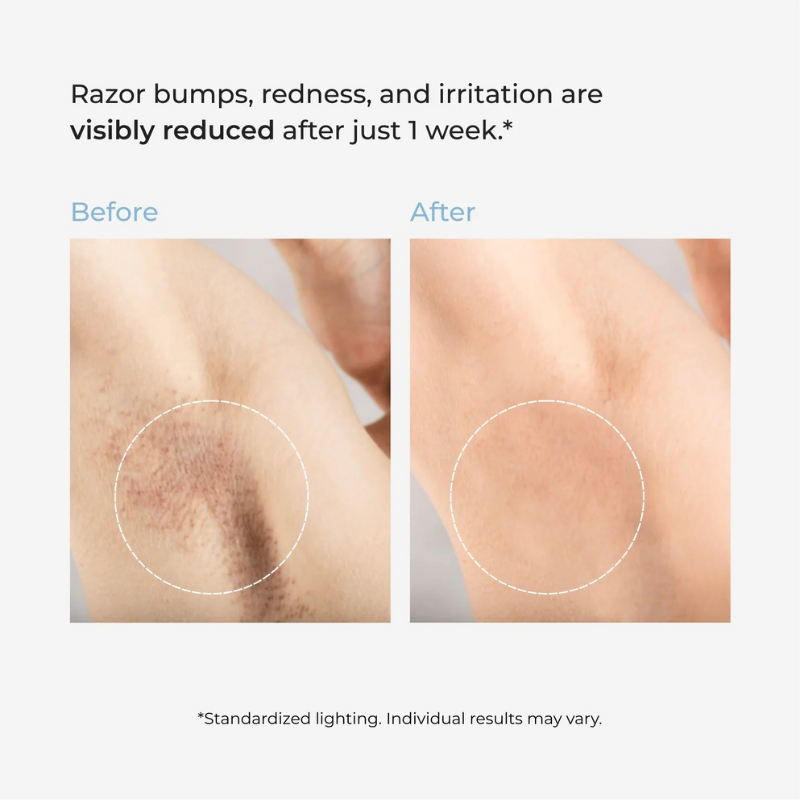 nūda.® Smoothing Solution Ingrown Hair Treatment